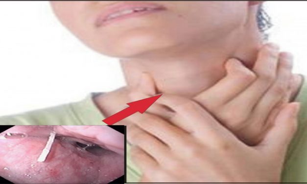 CARA CEPAT DAN ALAMI ATASI TERSEDAK DURI IKAN