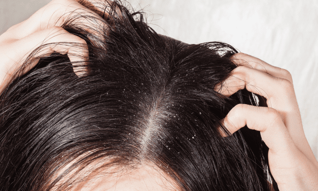 CARA MENGATASI KETOMBE YANG TERBILANG AMPUH