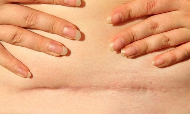 KETAHUILAH LAMA PENYEMBUHAN LUKA OPERASI DAN FAKTOR YANG MEMPENGARUHI NYA