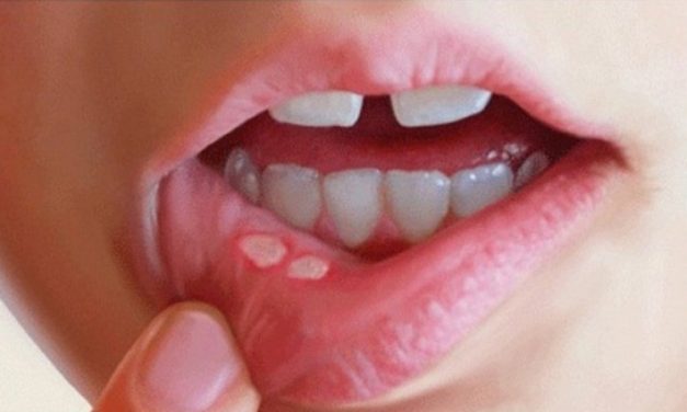 CARA MENGOBATI SARIAWAN DENGAN BAHAN ALAMI