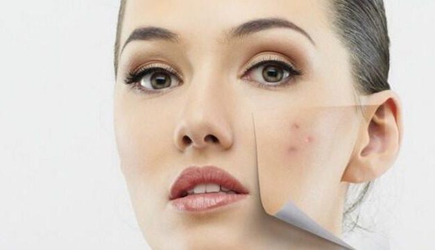 CARA MENGHILANGKAN JERAWAT DI WAJAH SECARA CEPAT DAN ALAMI